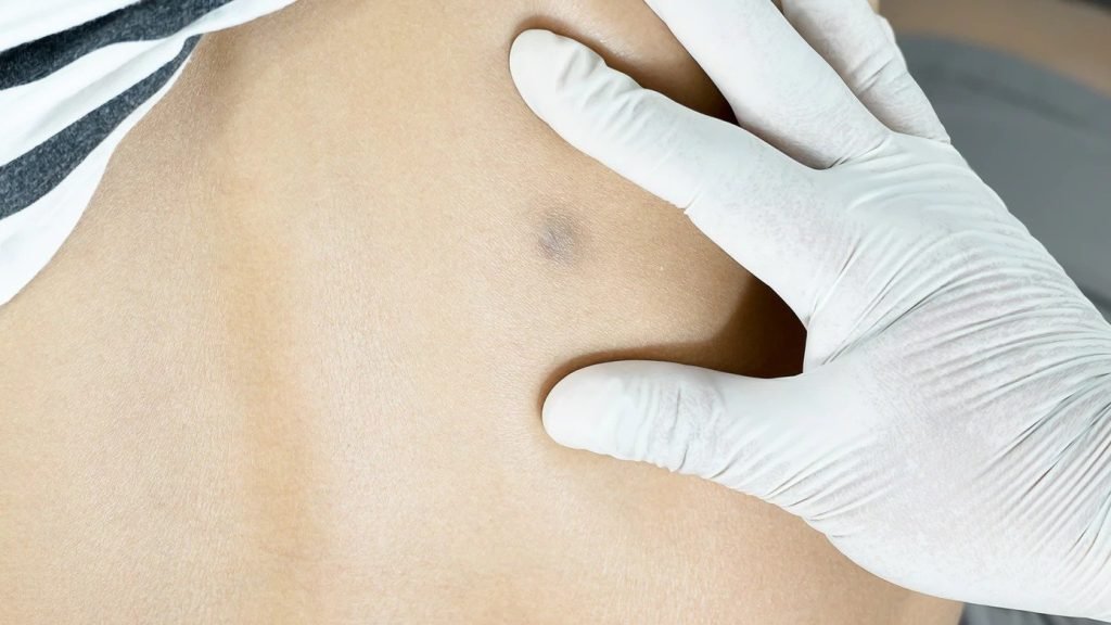 Lump in any part of the body cancer symptom