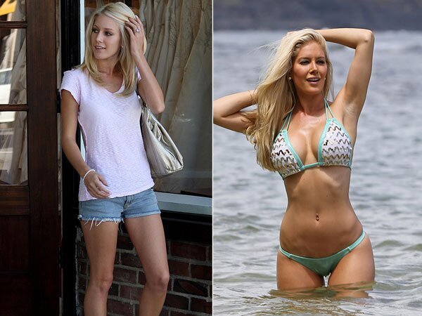 Cosmetic Surgeries gone wrong