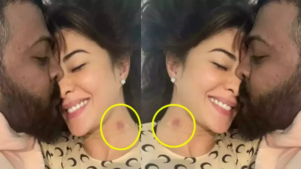 Jacqueline Fernandez's love bite