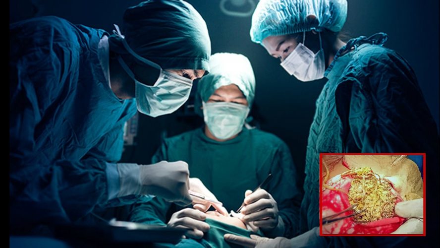 Over 1.5 Kg Jewellery And 90 Coins Removed From a 26 Years Old Woman’s Stomach