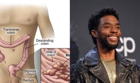 Causes, Methods, And Prevention Of Colon Cancer Which killed Chadwick Boseman (Black Panther) Chadwick Boseman