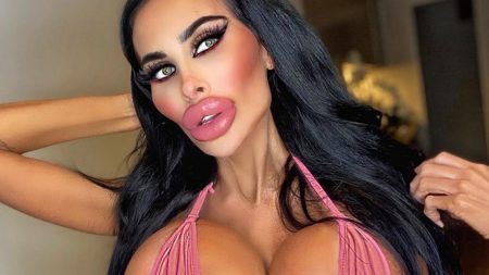 Plastic Surgery Of A Women Goes Horribly Wrong On Which She Spent 97 Lakhs