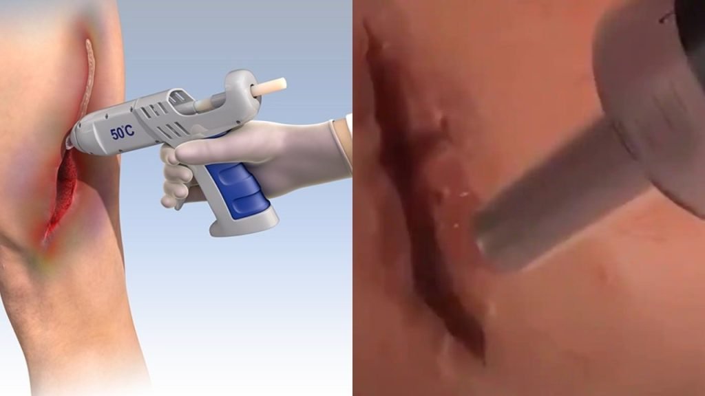 Sound’s Innovative: The Wounds And Cuts To Be Glued Soon Glue for cuts and wounds